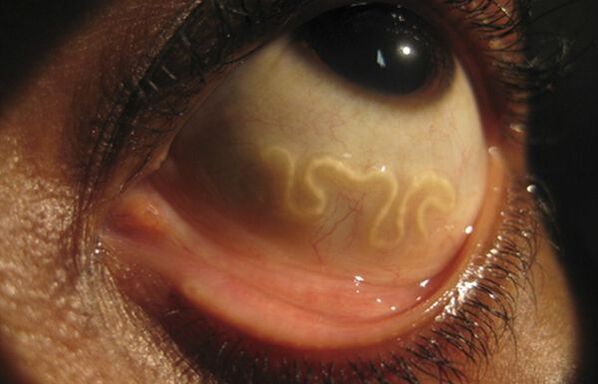 O verme Loa Loa vive no olho humano e causa cegueira